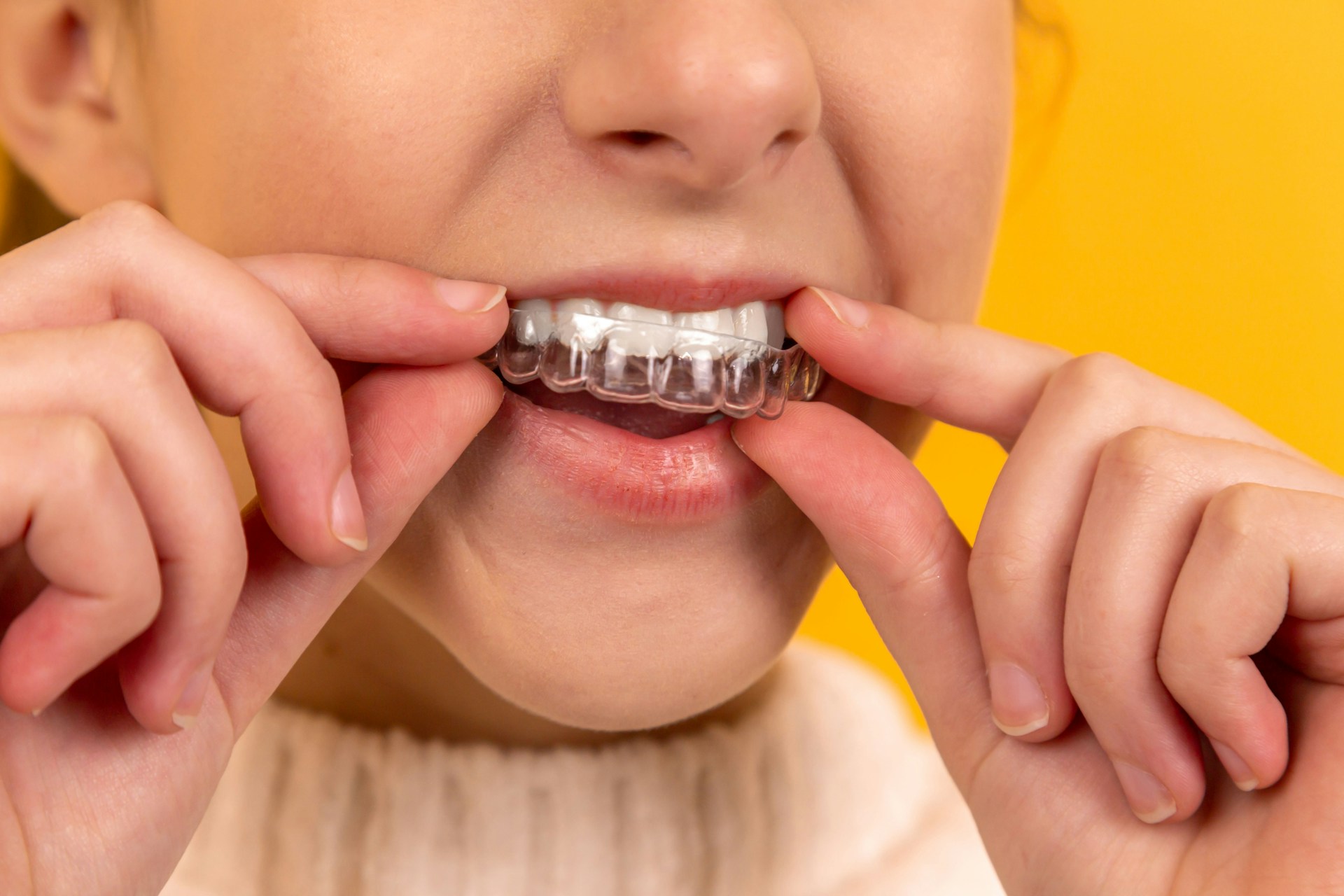 Ortodoncia - SmileClinic - Alfaz del Pi