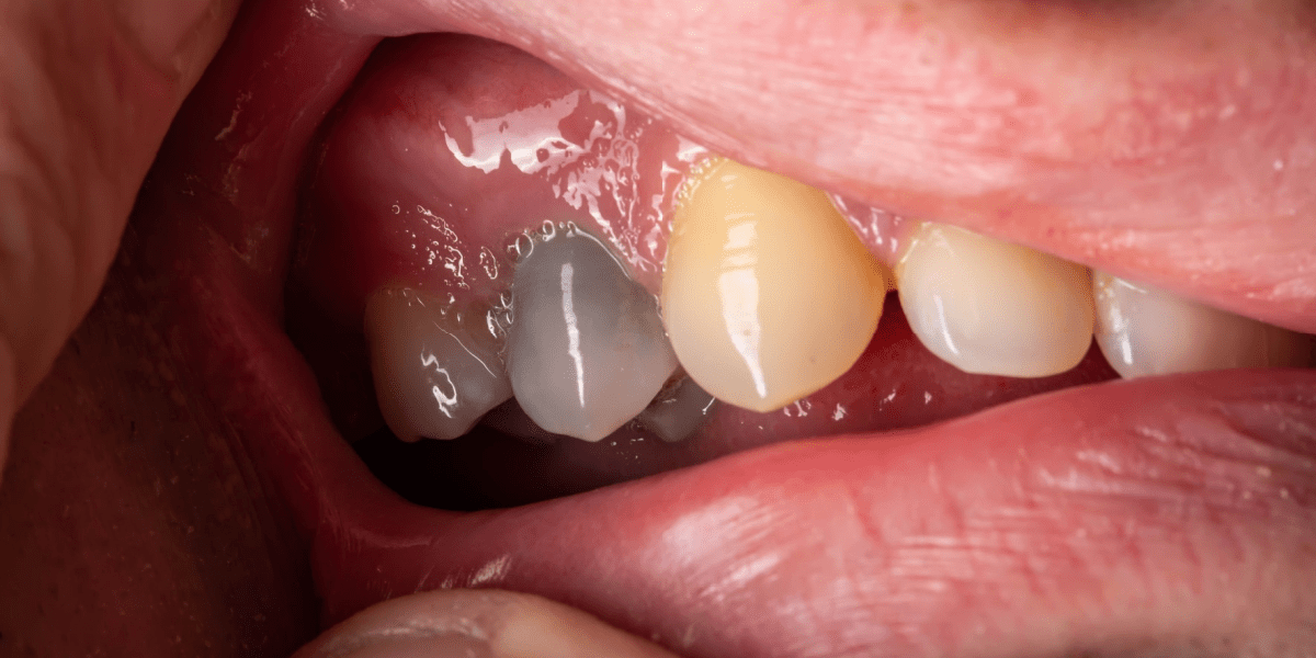 necrosis-dental-diente-negro