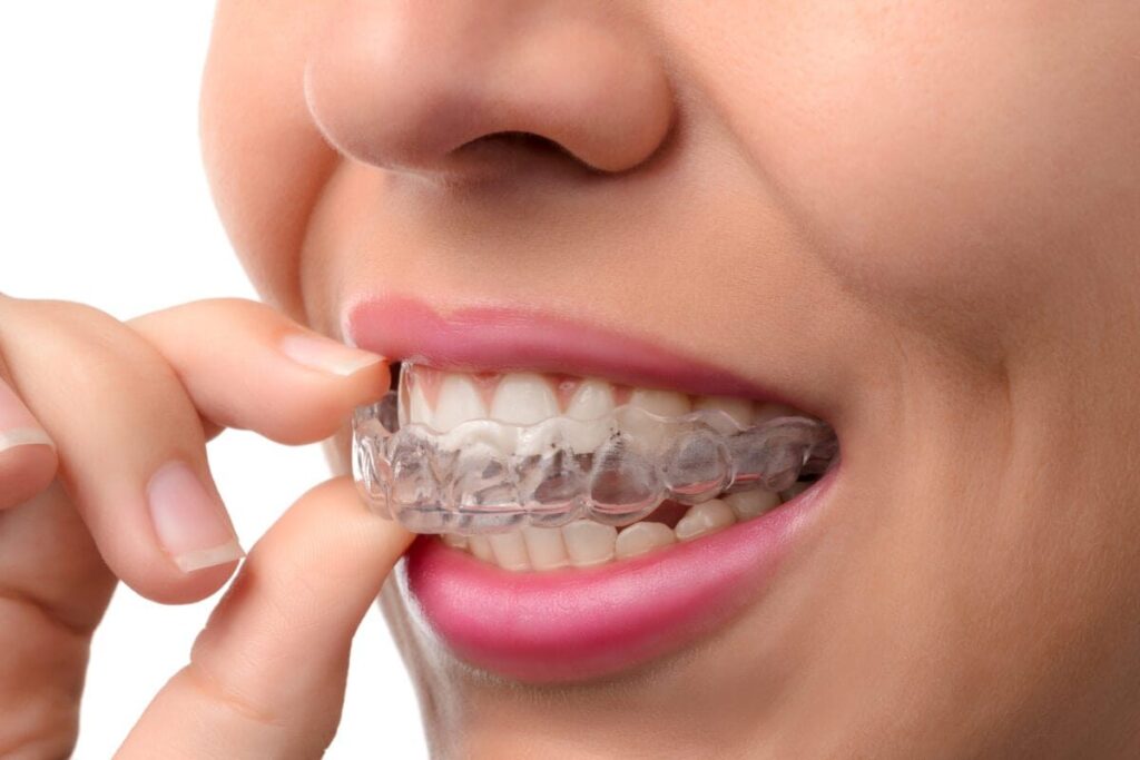 Cómo funciona la ortodoncia invisible SmileClinic - Alfaz del Pi