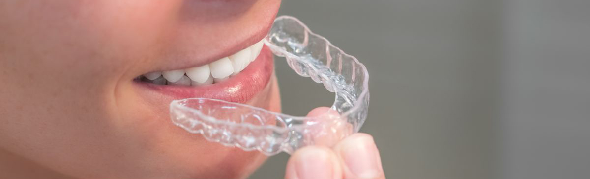 Cómo funciona la ortodoncia invisible SmileClinic - Alfaz del Pi