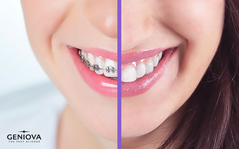 Ortodoncia invisible Geniova SmileClinic