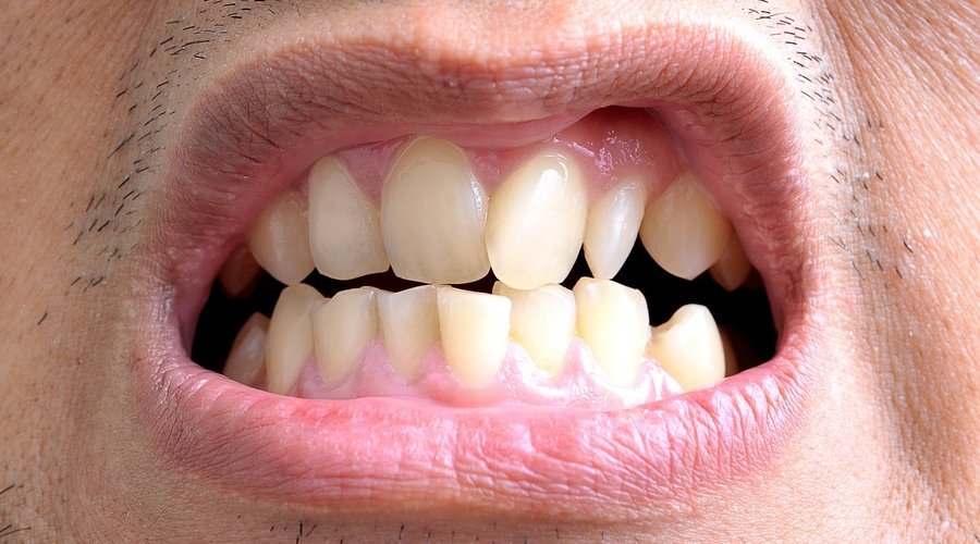  ortodoncia en adultos - Alfaz del Pi - SmileClinic - L'ALFAS