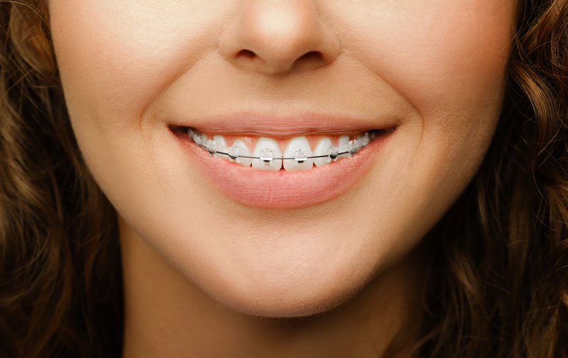 Brackets en Adolescentes SmileClinic