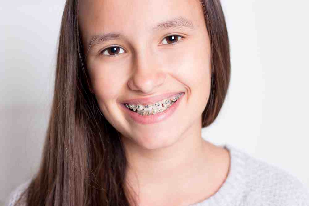 Brackets en Adolescentes SmileClinic - Alfaz del pi
