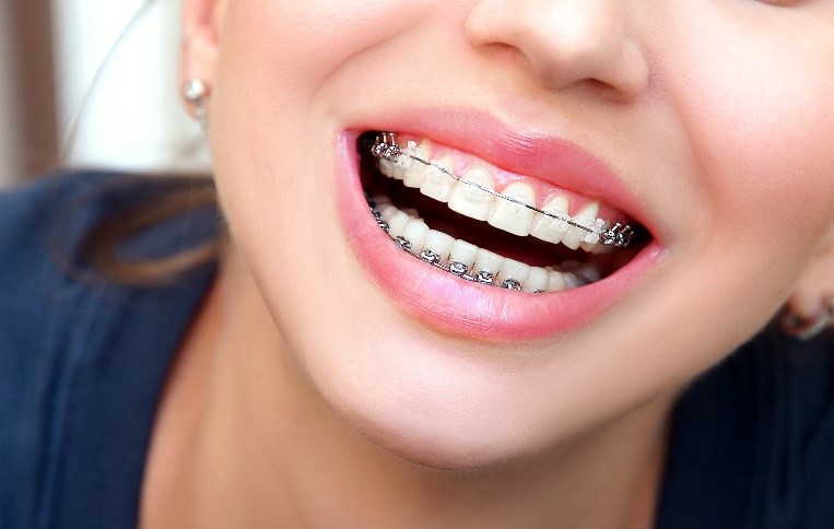 Brackets en Adolescentes