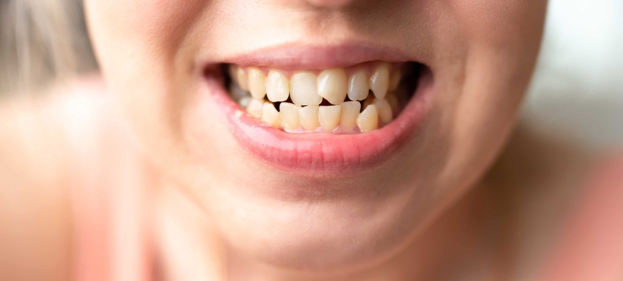 Desalineacion infantil - Smile Clinic - Alfaz del Pi