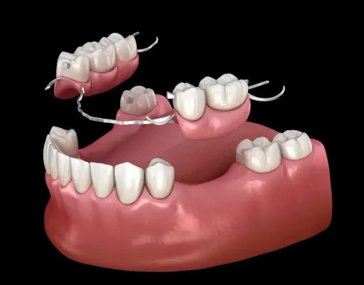 protesis-dental-removible- dentadura removible