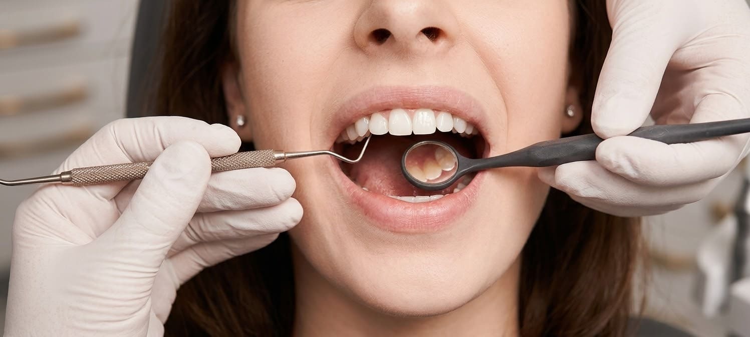 Erosión ácida dental en Alfaz del Pi