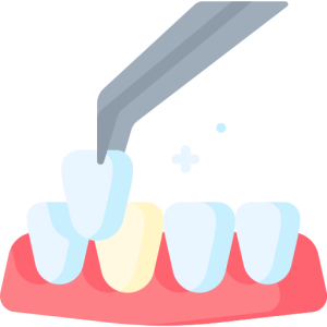 Carillas en Alfaz del PI, SmileClinic